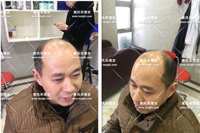 唐風采無痕假發 冒先生脫發