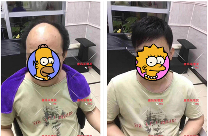 脫發謝頂 \