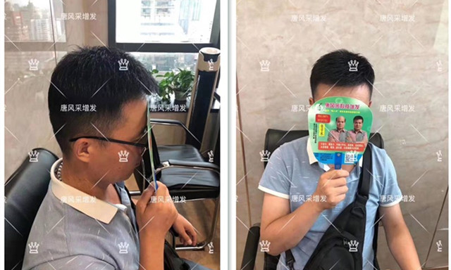 頭頂補發塊多少錢,超薄真發頭頂補發片 唐風采客戶案例