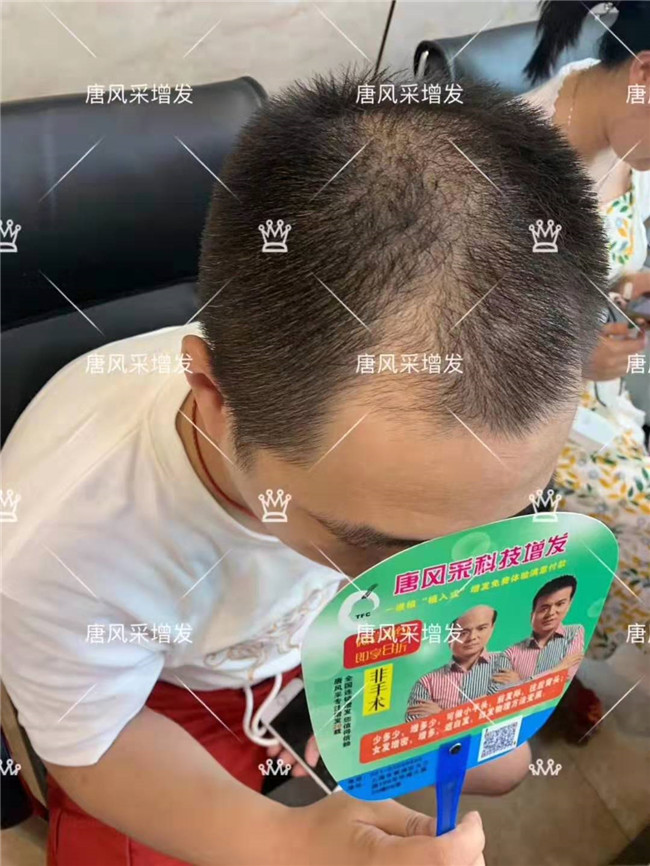 真假發,隱形假發 唐風采客戶案例