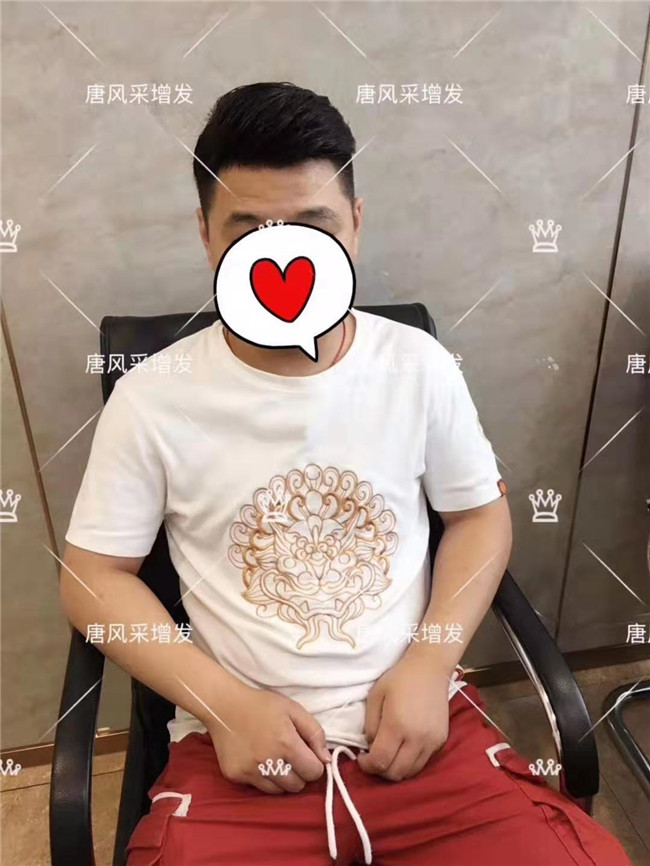 真假發,隱形假發 唐風采客戶案例增發后