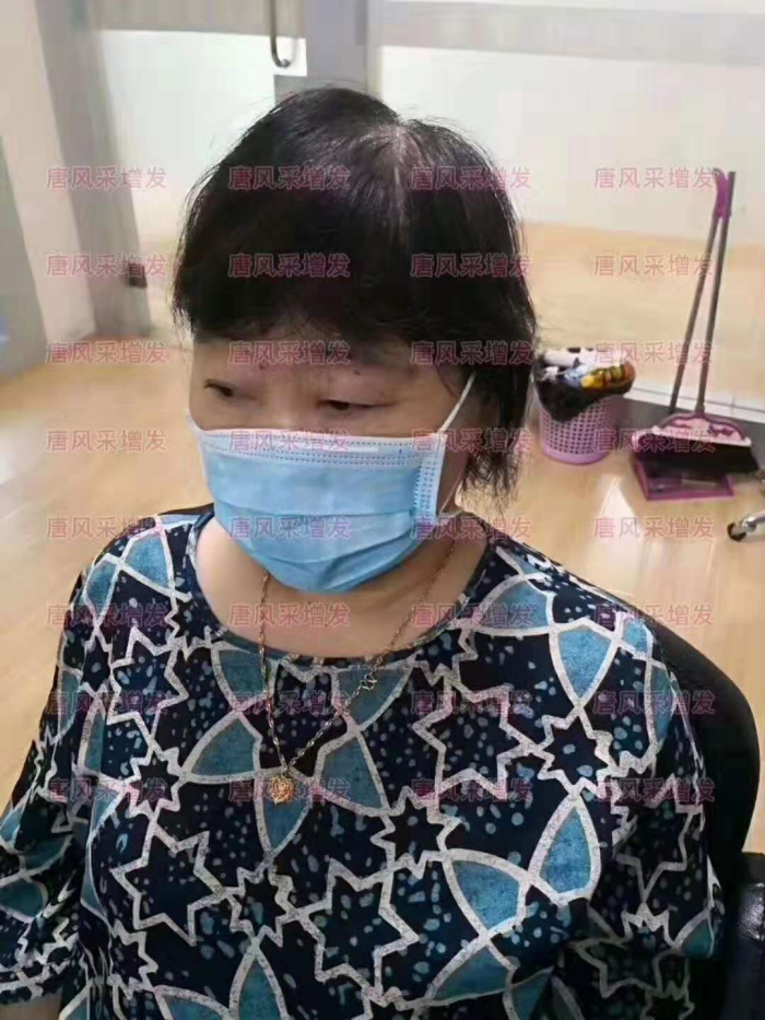 中老年女士頭發稀少