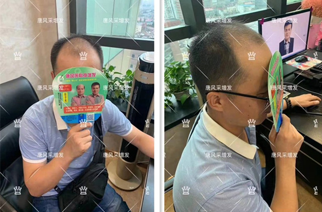 掩蓋禿頭的發(fā)型 禿頂