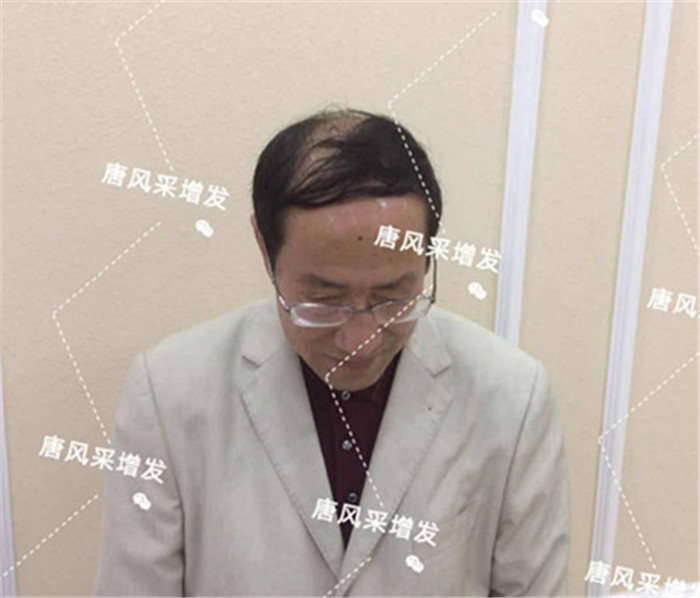 如何解決地中海脫發 謝頂