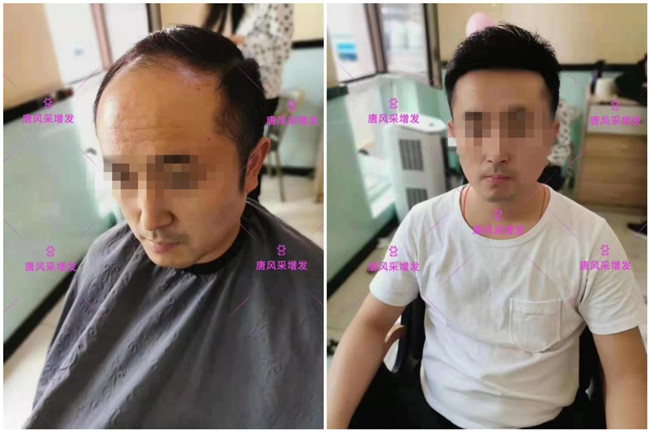 中老年頭頂假發片價格 唐風采客戶