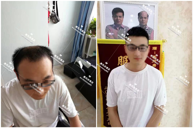 頭頂局部假發 唐風采假發可以戴著打球和游泳