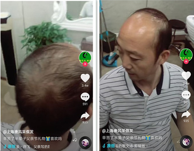頭頂局部假發 唐風采客戶案例