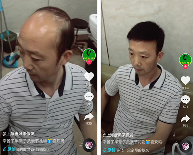 頭頂局部假發 唐風采客戶案例
