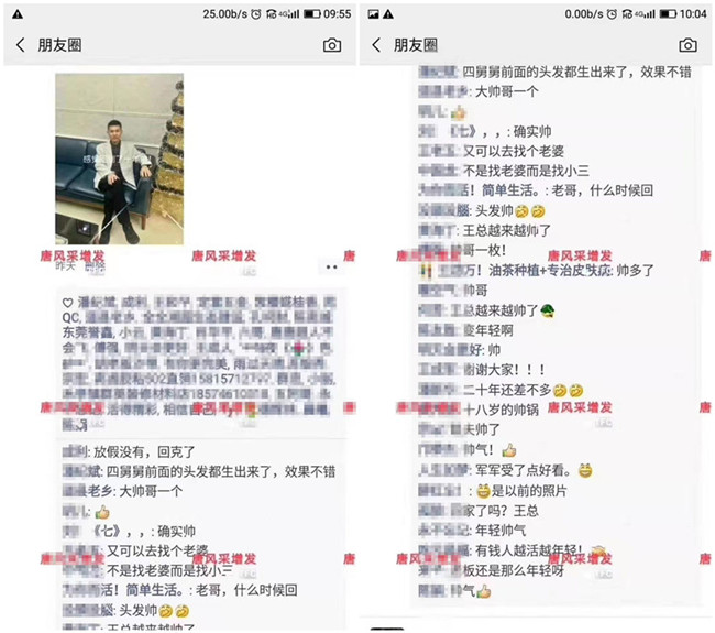 補發織發效果如何 王先生的朋友圈