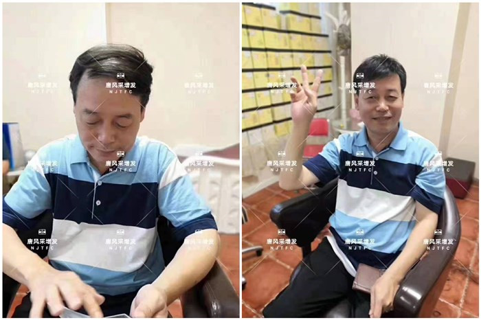 頭頂假發片 唐風采客戶李先生增發前后