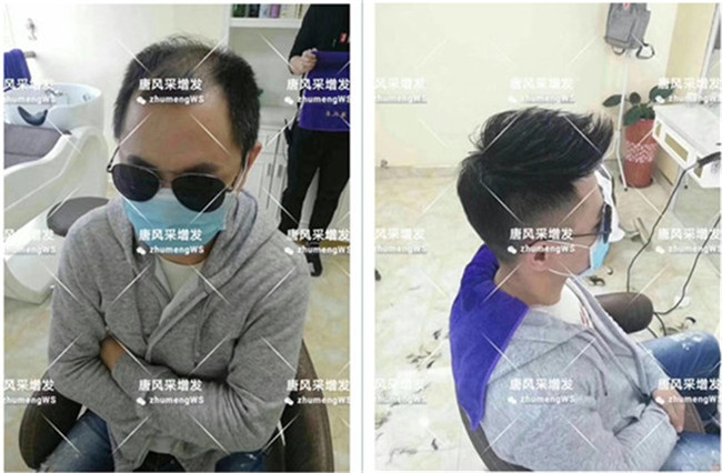 頭頂粘貼假發片 唐風采客戶章先生增發后