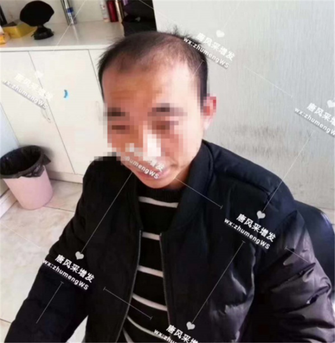 真人頭發的假發 唐風采客戶案例
