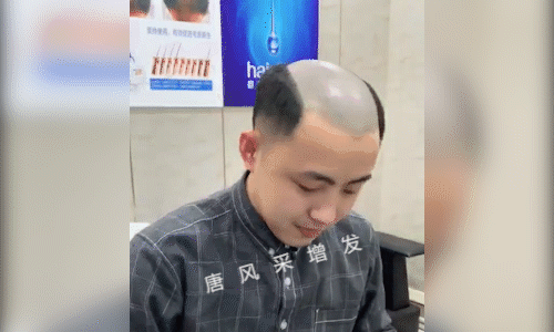 補發與假發的區別 織發補發適合局部脫發者