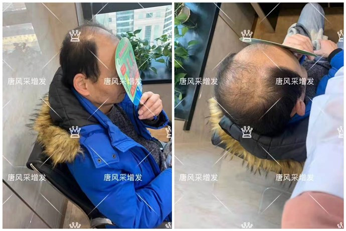 現在戴假發的人多嗎 \