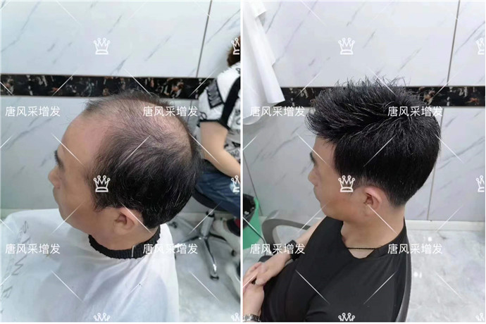 隱形假發 \