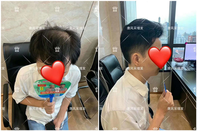 貼局部假發 \
