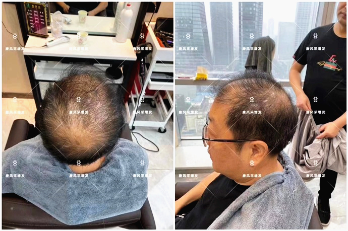 假發片頭頂補發片 \