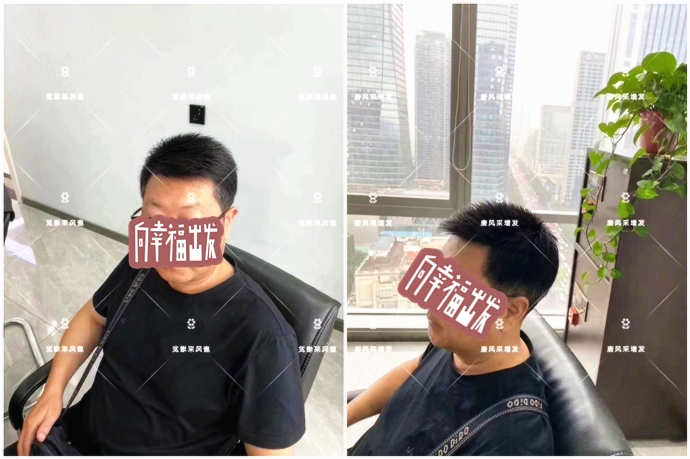 頭頂補發片 \