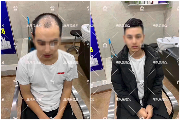 局部假發片 \