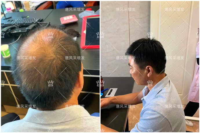 頭頂補發片買哪種好 \