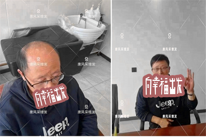 頭頂補發片買哪種好 \