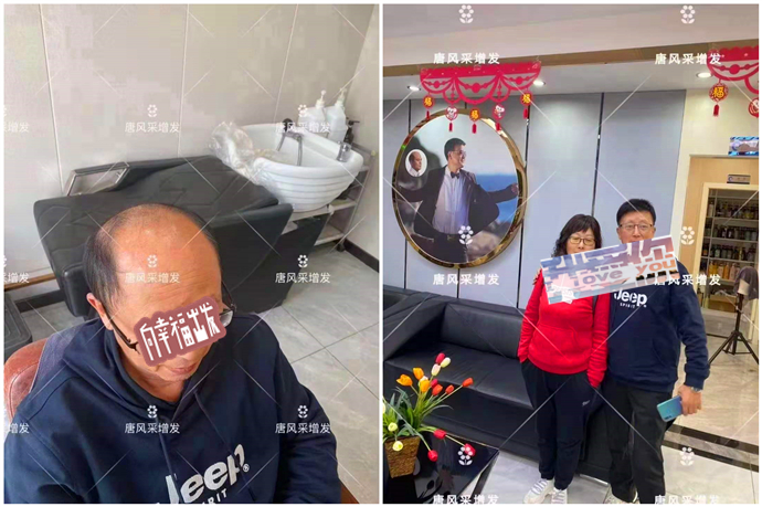 頭頂補發片買哪種好 \