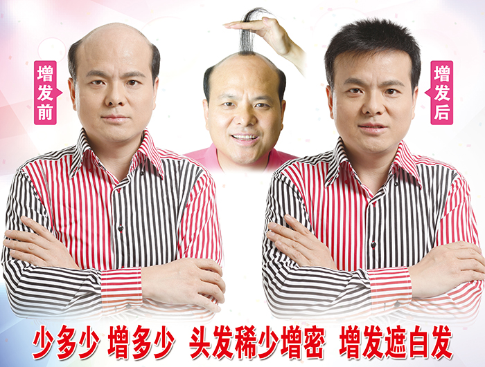 禿頂如何增發 \