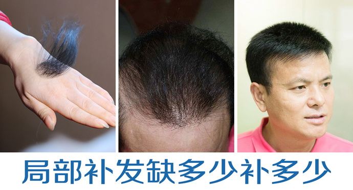 頭發太少做隱形增發 \
