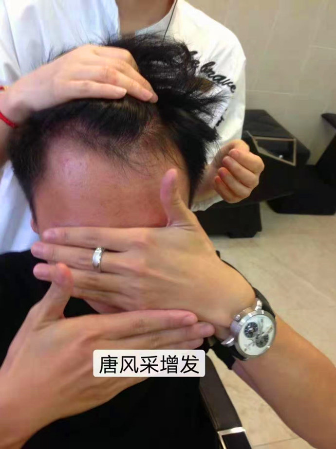 頭發太少做隱形增發 \
