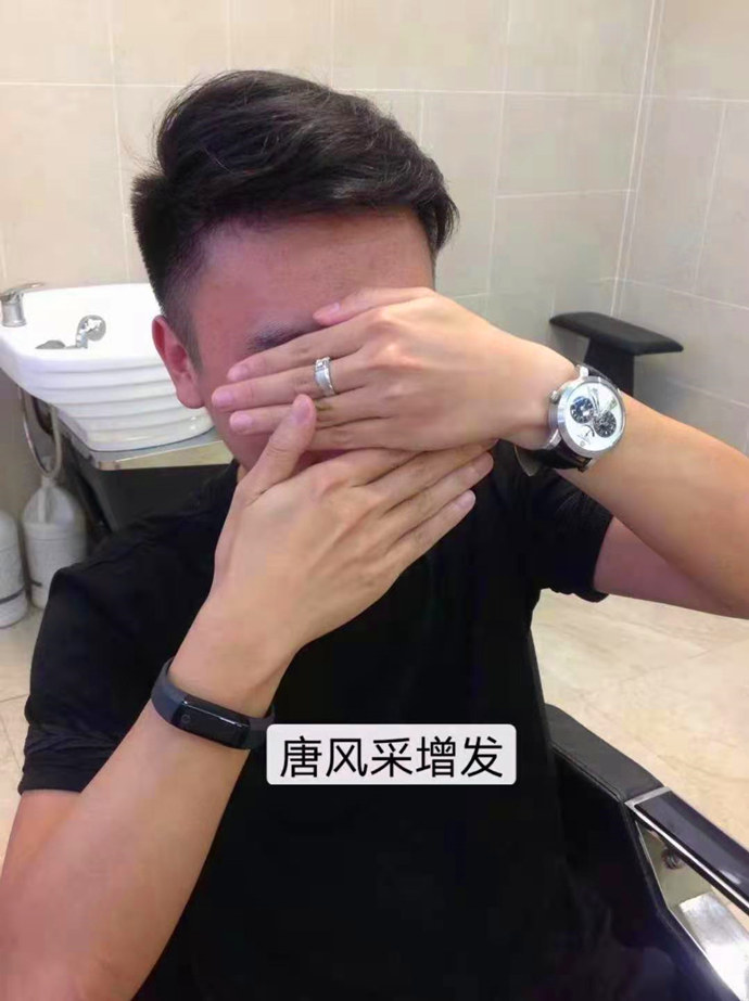 頭發太少做隱形增發 \