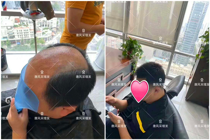 植發 \