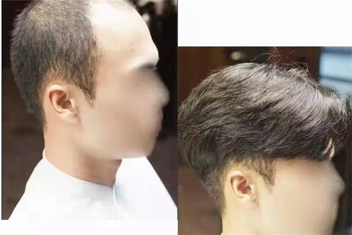 假發可以戴多久 \