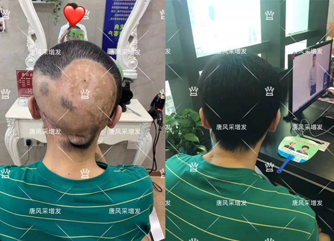 隱形假發 \