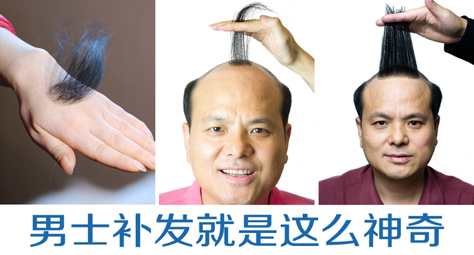 頭頂發量少 \
