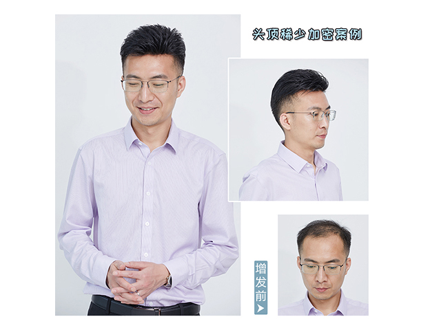 隱形增發對比照 \
