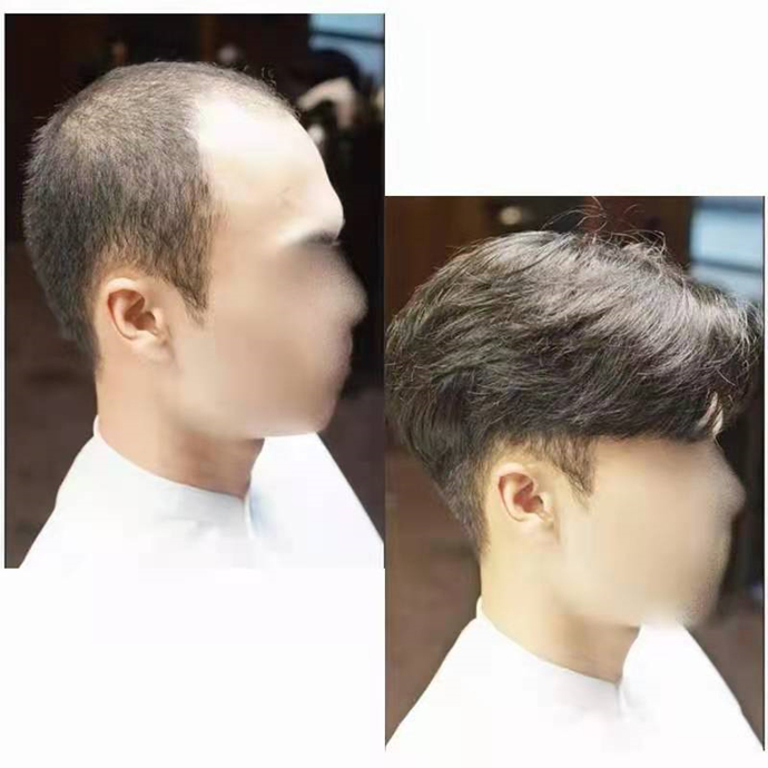 隱形增發對比照 \