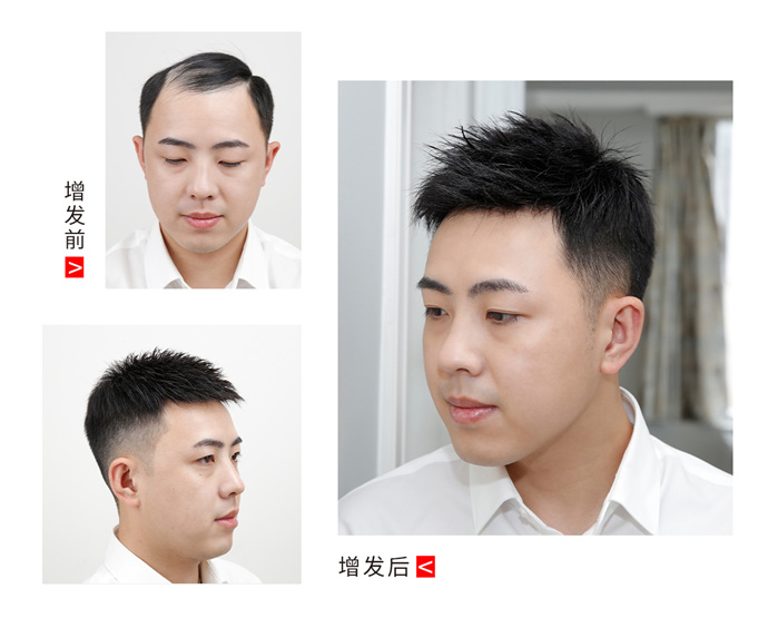 隱形男士假發