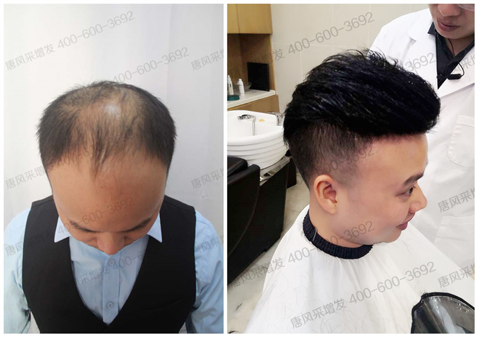禿頂能移植頭發么 \