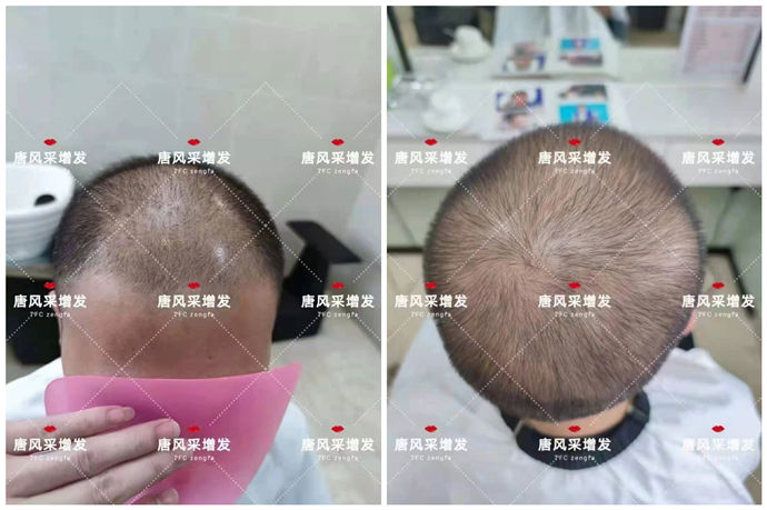 隱形男士假發 \