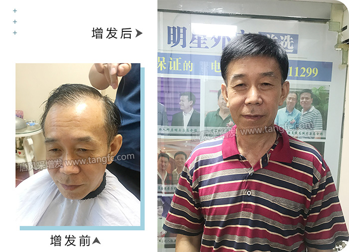 頭頂補發假發片 \