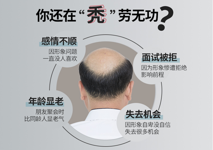男士頭頂補發 \