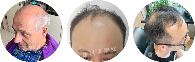 男士頭頂補發 \