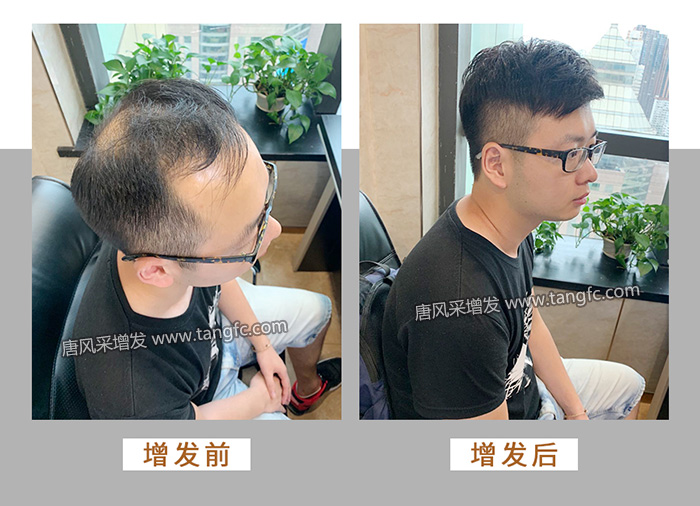 頭頂補發假發片 \