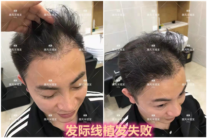 男士隱形補發哪家好 \