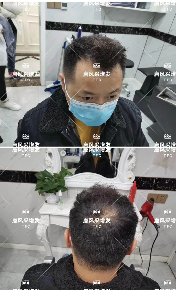 男士頭頂假發片效果好嗎 \