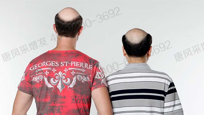 男士假發定制要多久時間 \