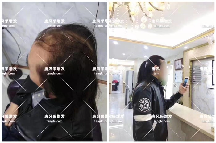 禿頂男士更適合哪種假發 \