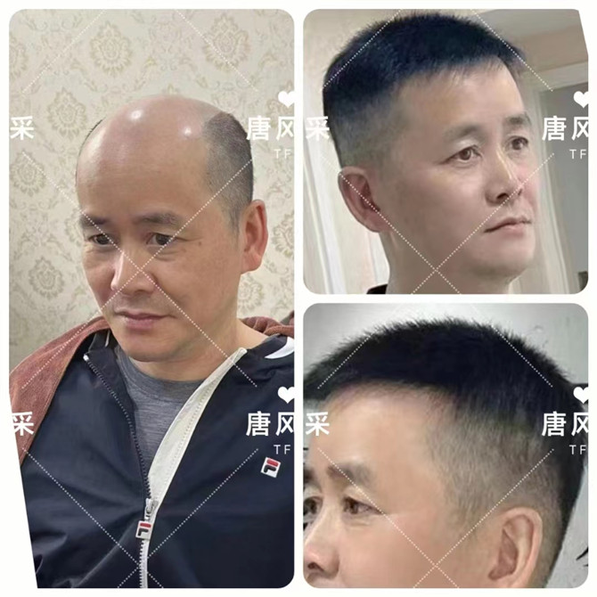 仿生長無痕假發 \