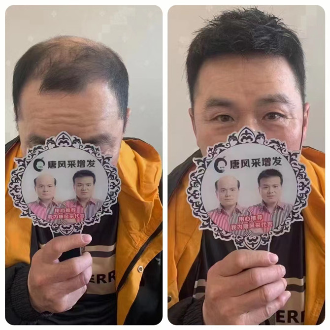局部隱形補發假發 \