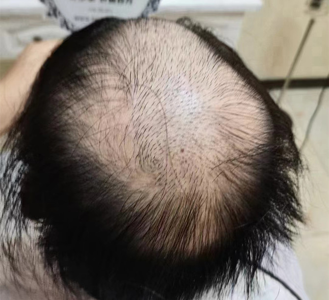 禿頭假發片 \